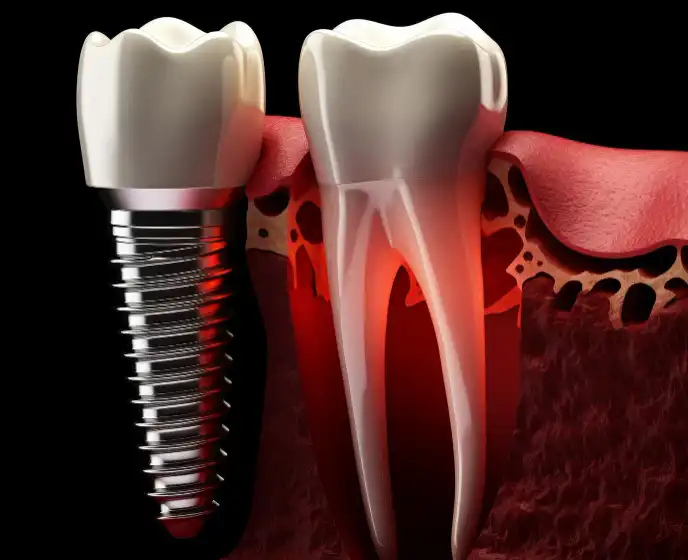 Implantes Dentales