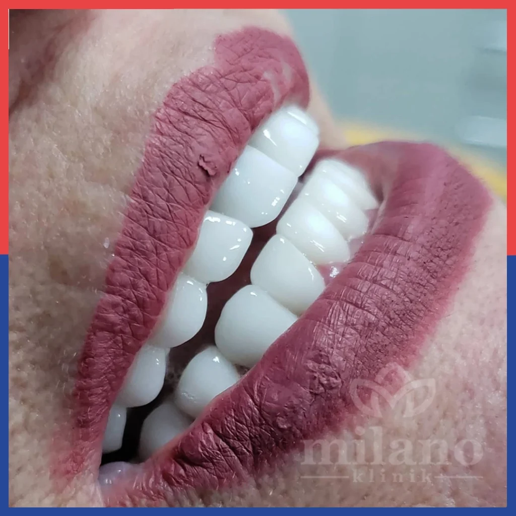 Zähne mit Veneers