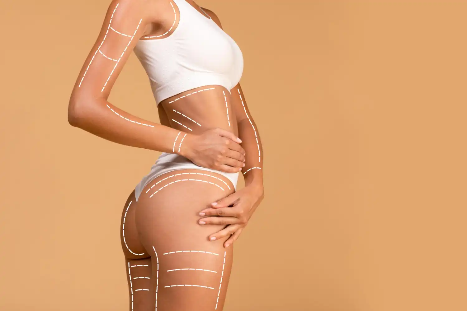 Fettabsaugung Cellulite