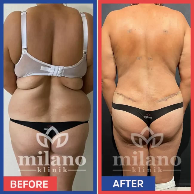 360-derece-liposuction-surgery-fiyatlari-cost-price-turkey-milano-klinik-clinic01