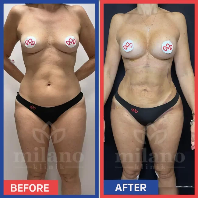 360-derece-liposuction-surgery-fiyatlari-cost-price-turkey-milano-klinik-clinic04