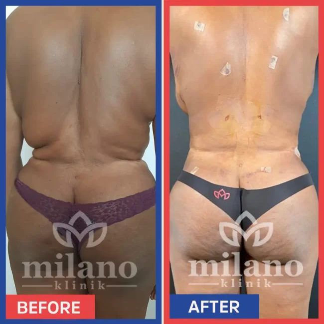 360-derece-liposuction-surgery-fiyatlari-cost-price-turkey-milano-klinik-clinic06