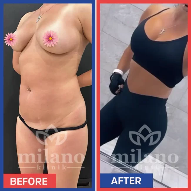 360-derece-liposuction-surgery-fiyatlari-cost-price-turkey-milano-klinik-clinic07