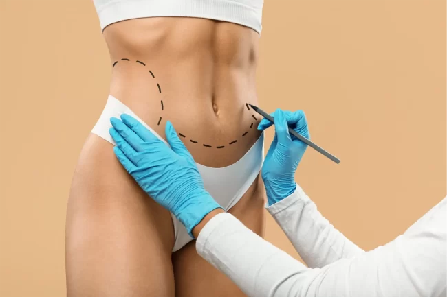 lipodem-op-turkei-vorher-nachher-kosten-milano-klinik03